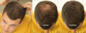 Haarverdichtung: Vorher-Nachher mit Cover Hair