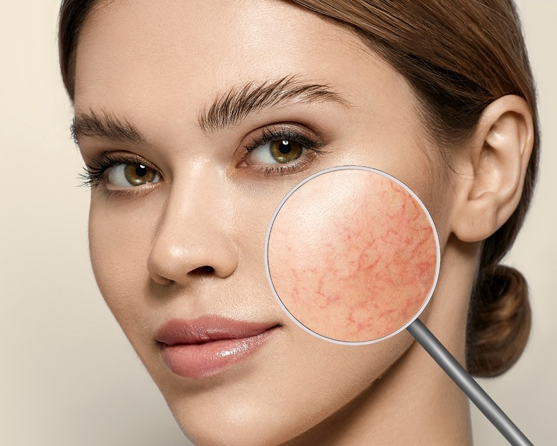 Couperose Ursache und Behandlung BellAffair.de